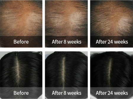 Szampon przeciw wypadaniu włosów 530 ml (Dermatical Hair-Loss Shampoo) LADOR