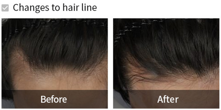 Szampon przeciw wypadaniu włosów 530 ml (Dermatical Hair-Loss Shampoo) LADOR